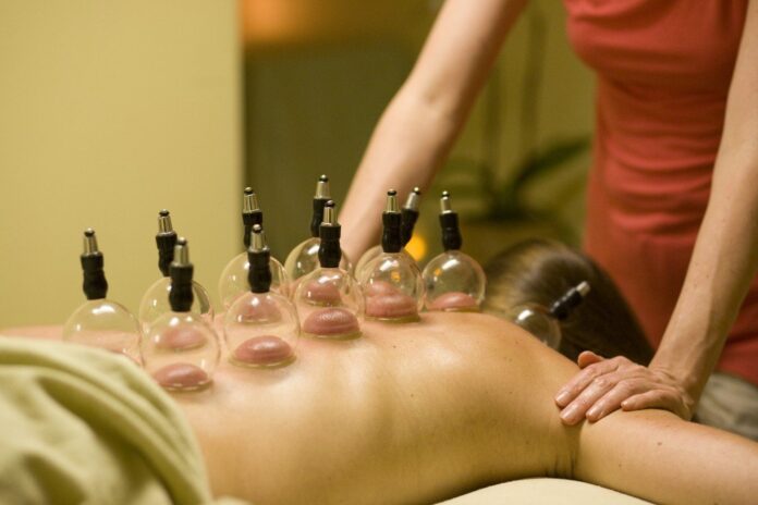 cupping treatment Melbourne