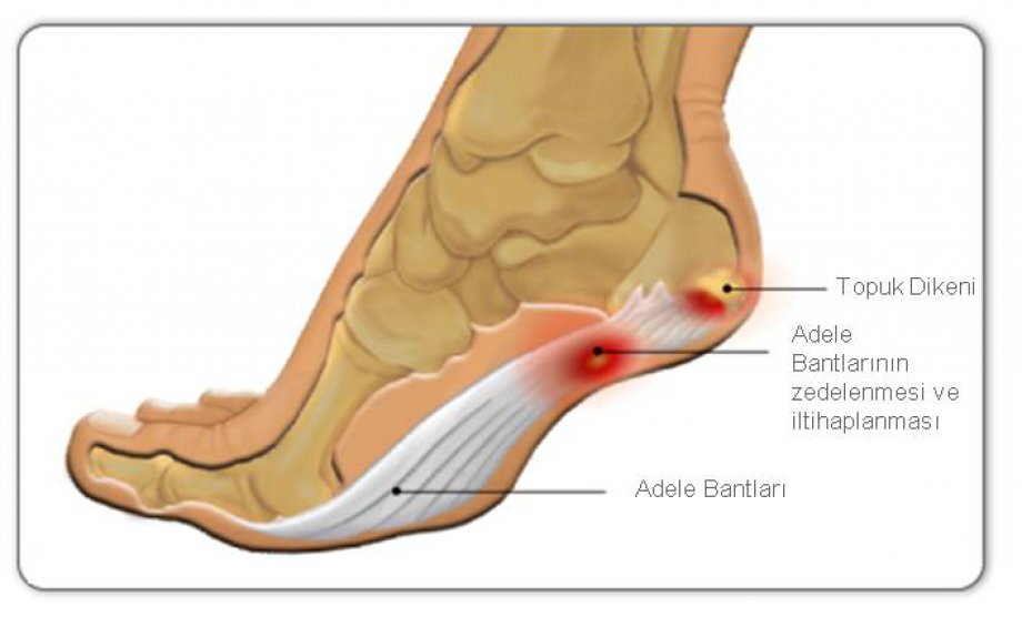 doctor recommended shoes plantar fasciitis