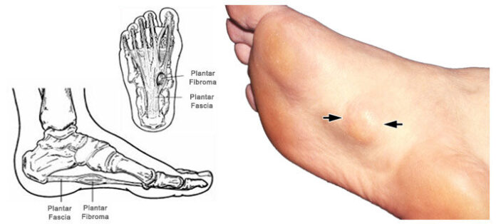 doctor recommended shoes plantar fasciitis