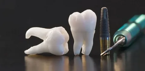  dental implants Leichardt
